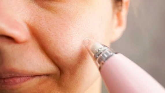 Eclat Alpin : Comment éliminer efficacement les points noirs sur le nez et le visage ?